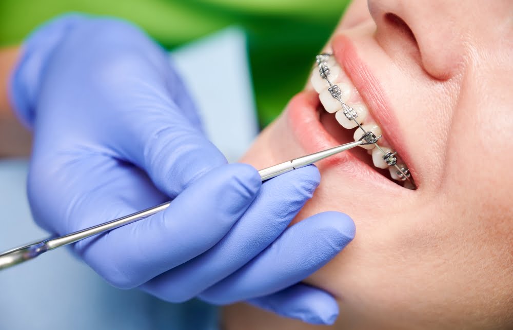 Dental braces adjustment in Georgetown, TX